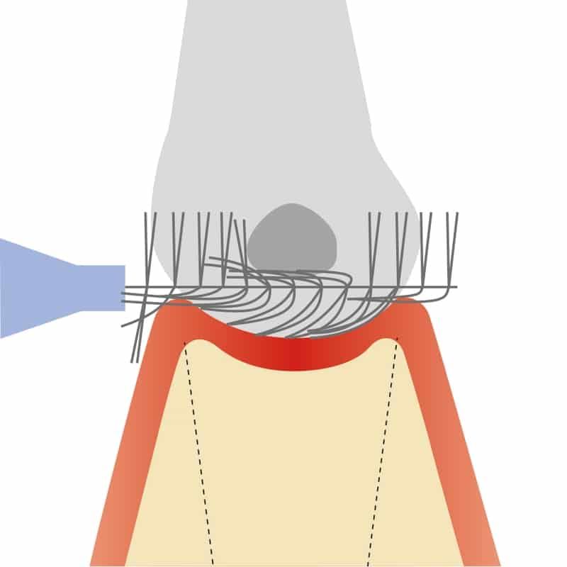 Zeichnung: Solo Prophylaxe