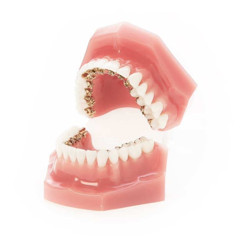Innenliegende Zahnspangen